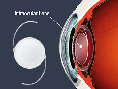 Intraocular lens