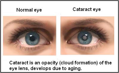 cataract eye