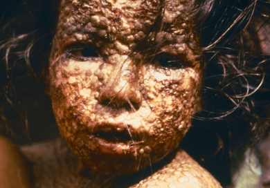 Infant with smallpox